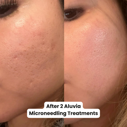 M8 MicroneedIing Pen