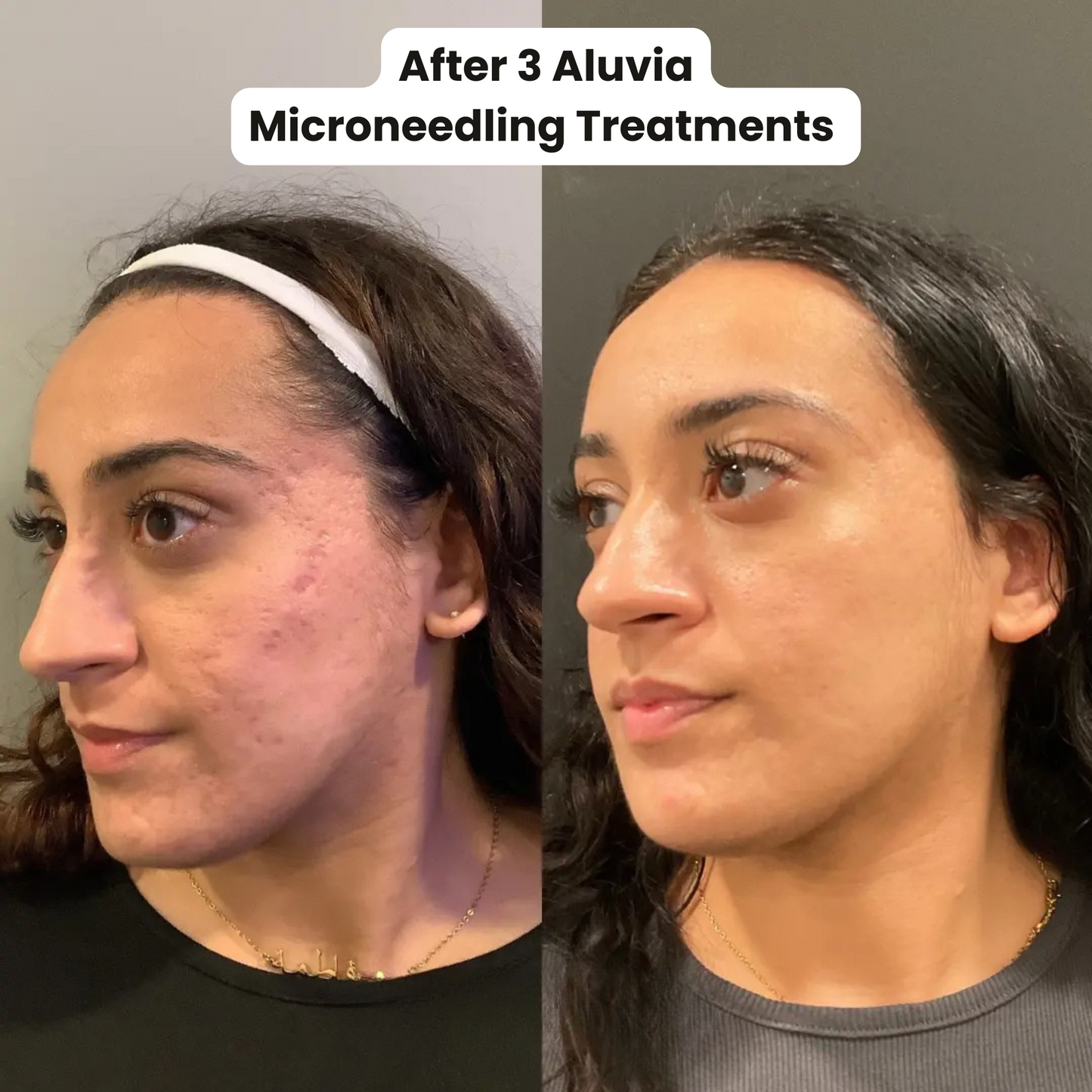 M8 MicroneedIing Pen